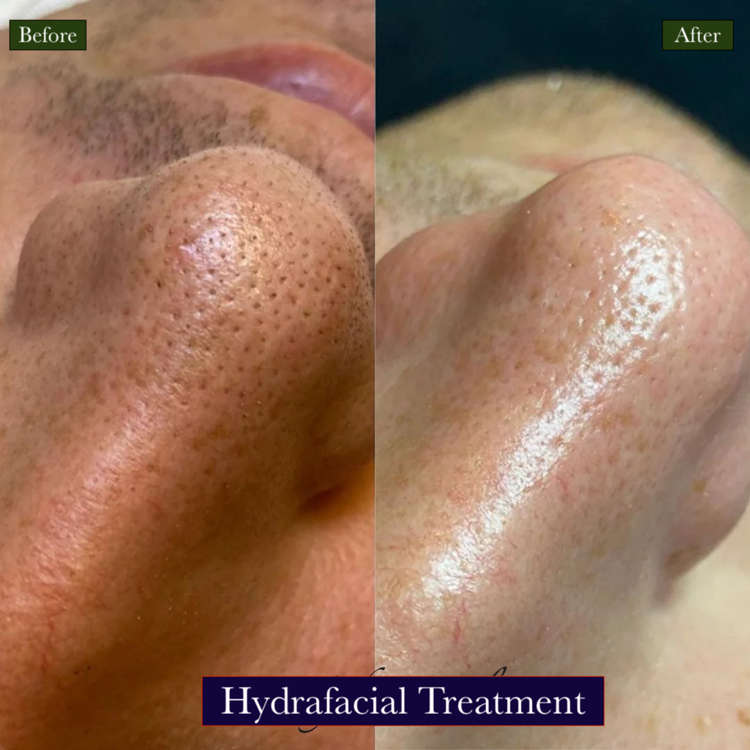 HydraFacial Treatment